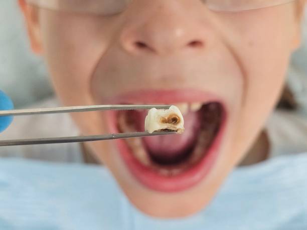 Best Emergency Wisdom Teeth Removal in Waterville, NY